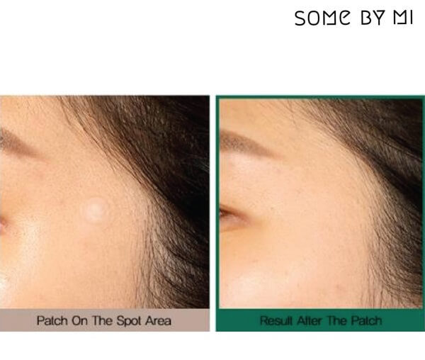 Miếng dán trị mụn Clear Spot Patch